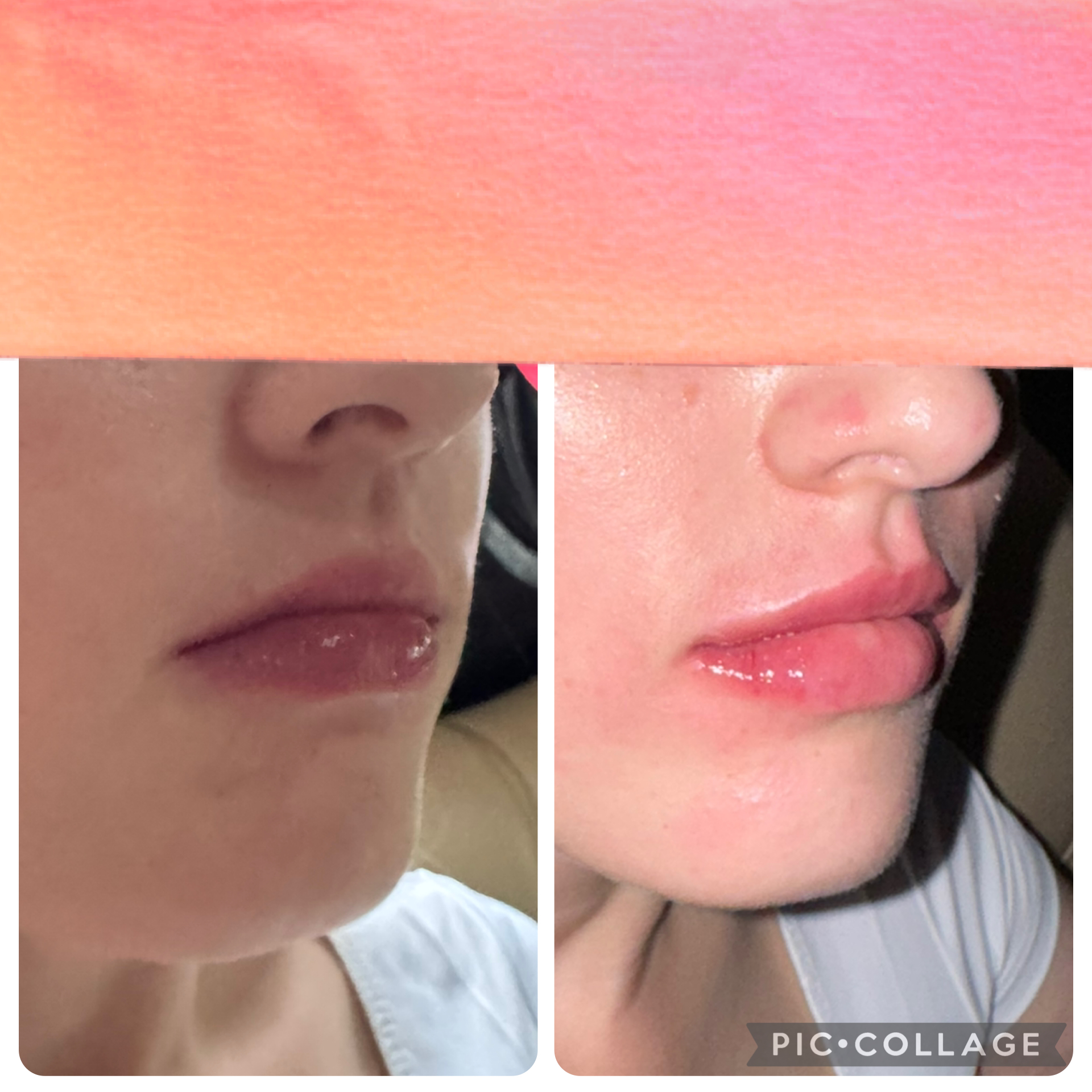 Lip augmentation example 1
