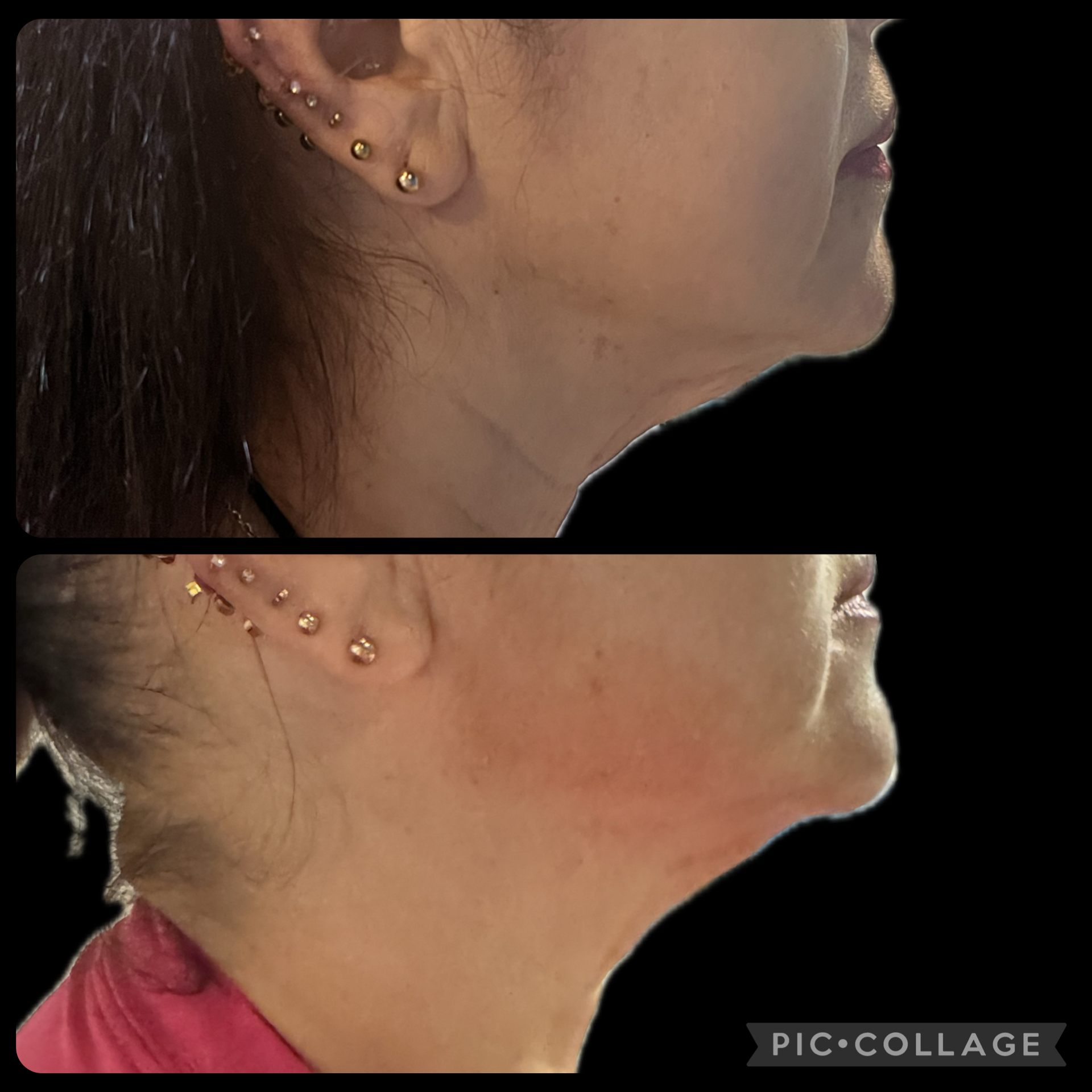 Jawline and chin contouring example