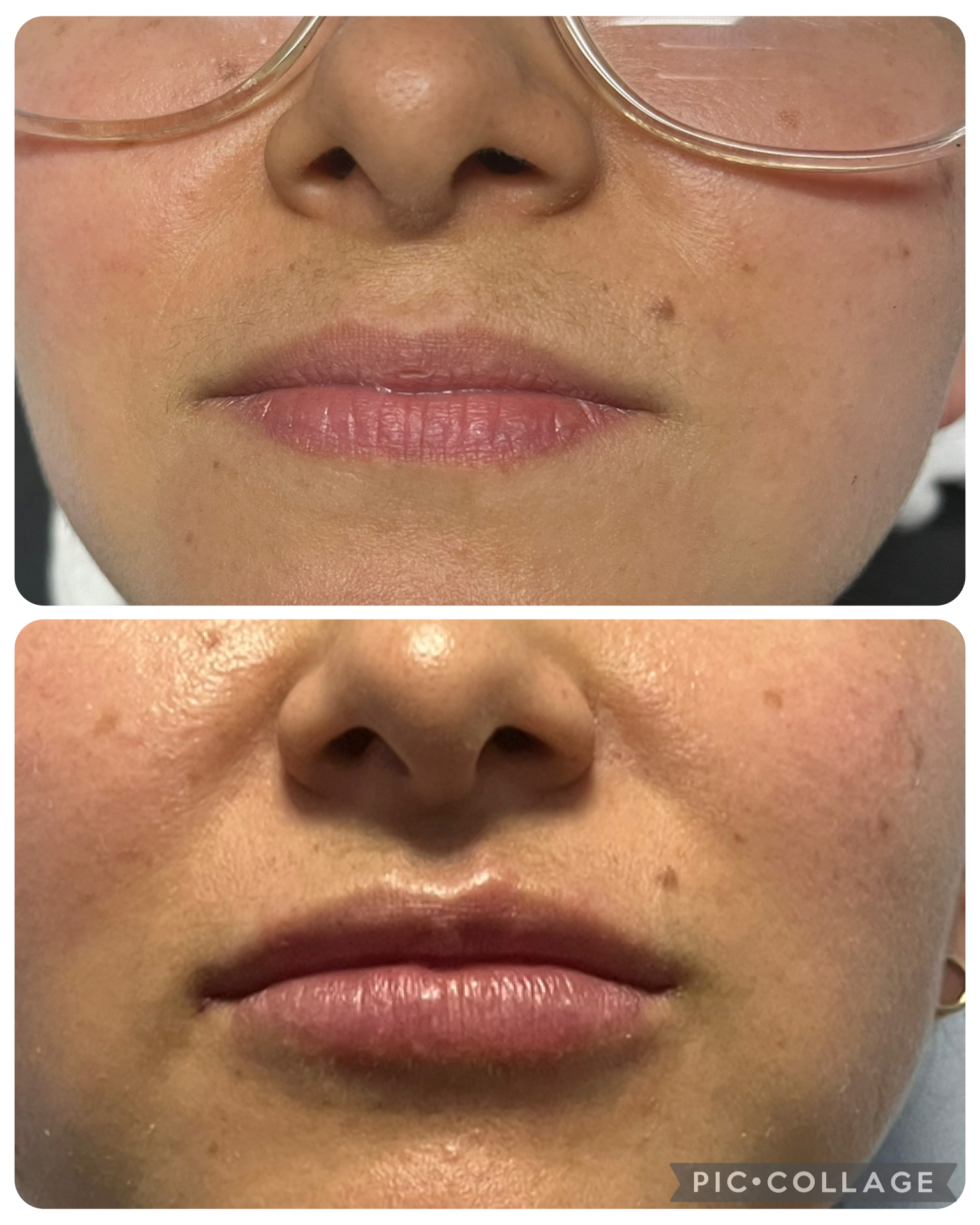 Lip augmentation example 2