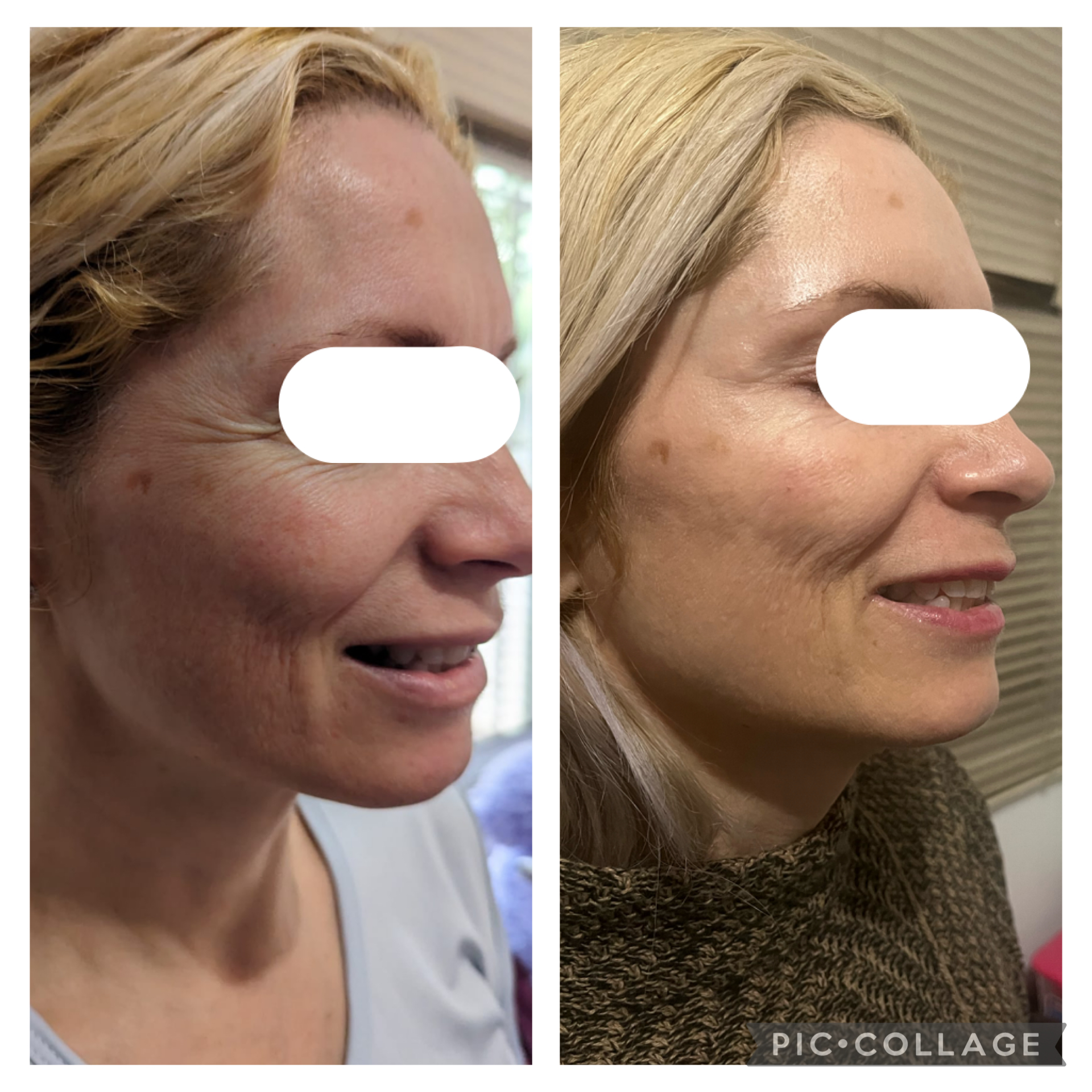 Crow's feet treatment example