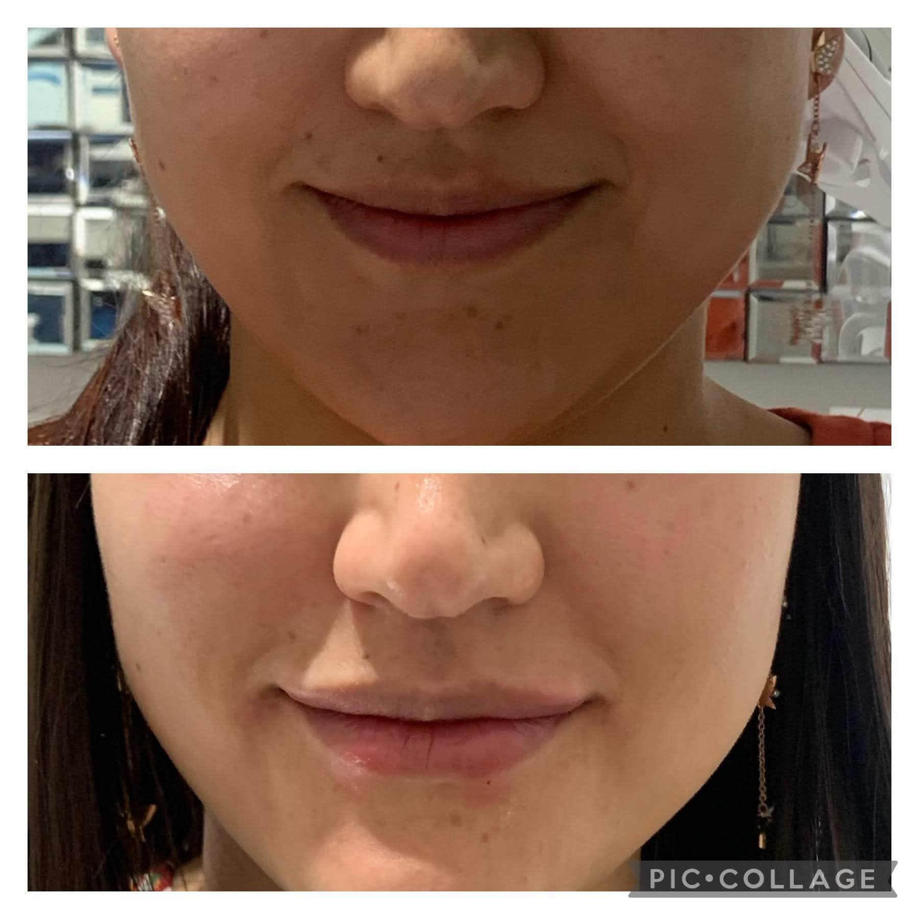 Lip augmentation example 3