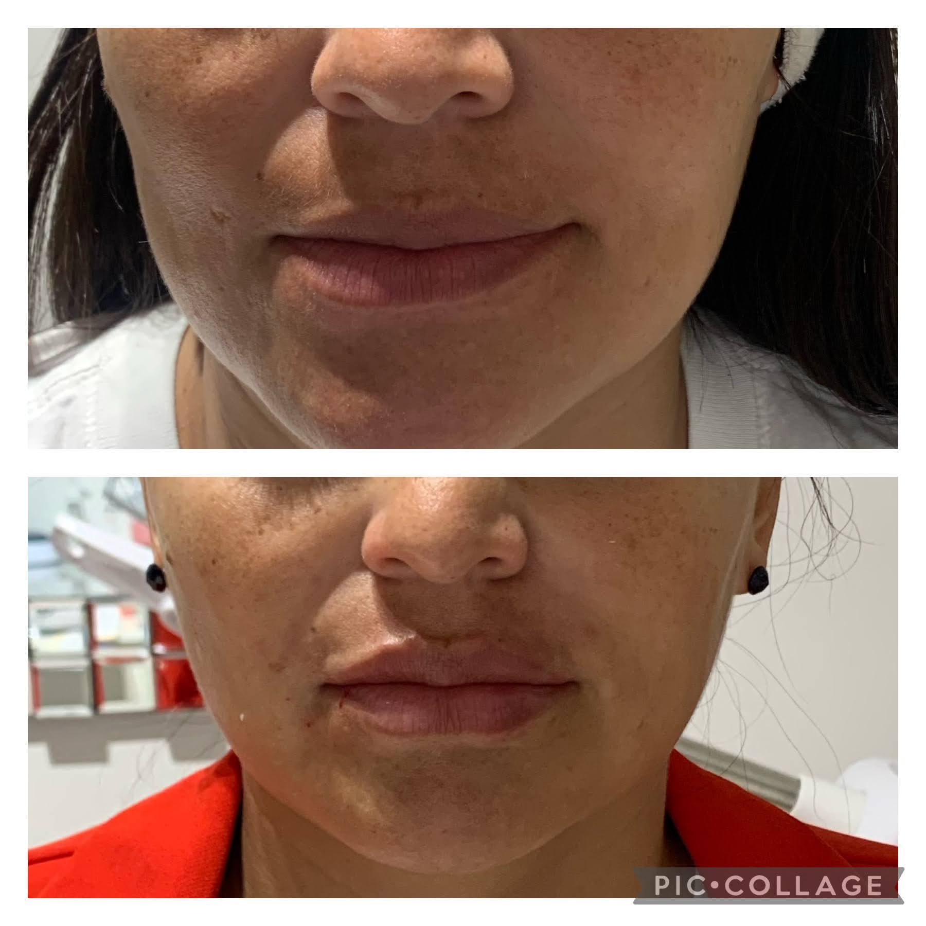 Lip augmentation example 4