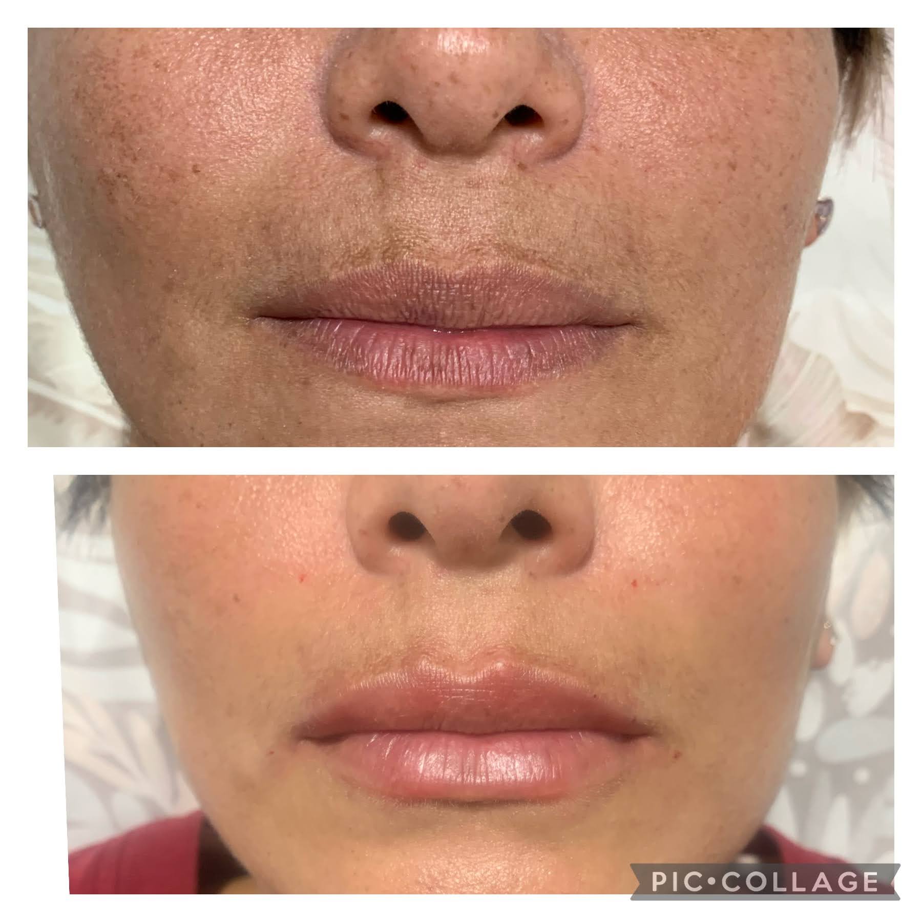 Lip augmentation example 5